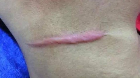 老人轻微擦伤有危险吗？伤口愈合慢会不会致命？专家暖心解读